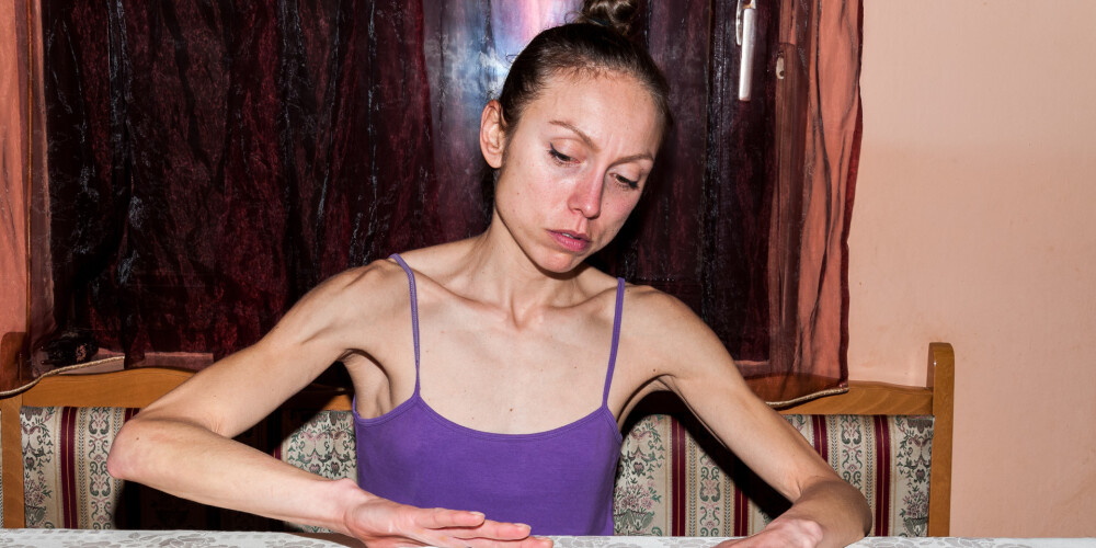 "Biju ellē!" - Laura no anoreksijas cieta 3 gadus. Atklāti par slimības postošo ietekmi un kā no tās izglābties