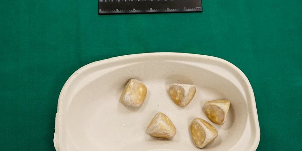 Ārsti ko tādu nebija redzējuši 30 gadus - pacientam Rīgā no urīnpūšļa izoperē 5 lielus akmeņus