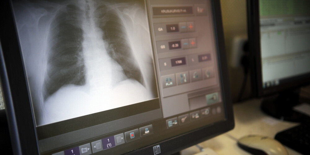 Onkoloģe Eva Vecvagare: "Covid-19 ir īpaši bīstams plaušu vēža pacientiem"