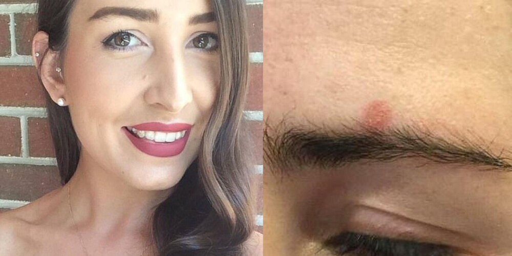 Небольшой прыщик на лице девушки оказался раком кожи, который чуть ее не убил