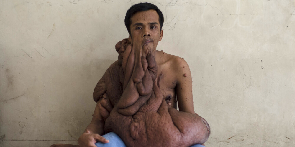 Родинка на лице мужчины превратилась в ужасную 40-килограммовую опухоль