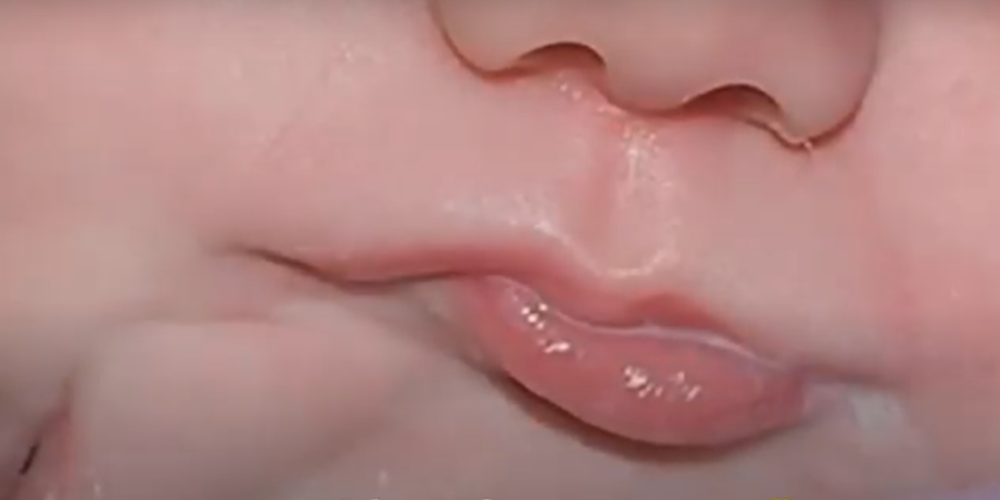 Ārstiem izdodas veiksmīgi veikt operāciju mazulim, kurš piedzimis ar retu parādību - divām mutēm