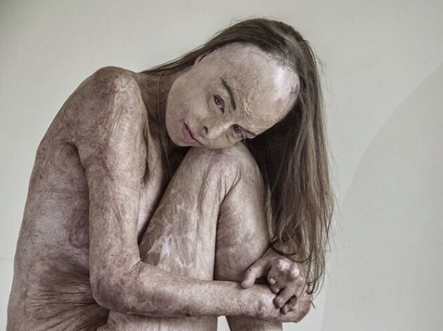 Ивестный британский фотограф Брайан Кэсси снял Кэрол сняться обнаженной, чтобы показать, как изменил ее пожар