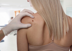 Dermatologs kliedē 10 populārākos mītus par melanomu