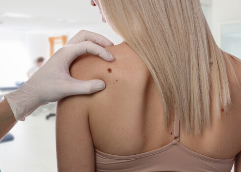 Dermatologs kliedē 10 populārākos mītus par melanomu