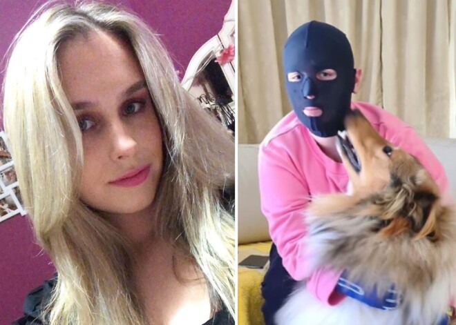 Девушка, чья семья погибла при извержении вулкана, показала, каких ожогов стоило ей спасение