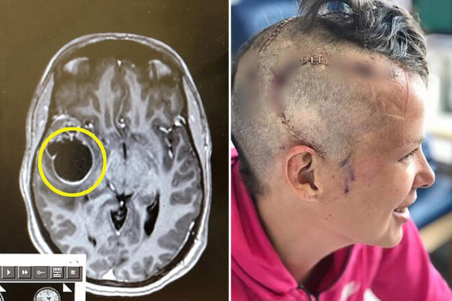 Magnētiskās rezonanses tomogrāfija apstiprināja, ka Lizijai ir 4. stadijas glioblastoma.