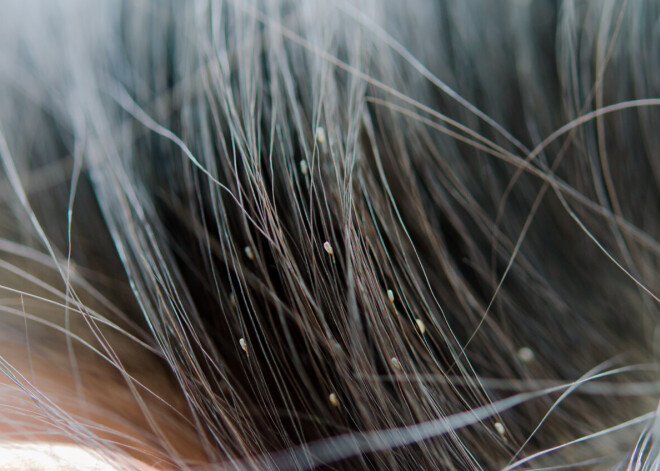 Vecāku bieds – utis, spalīši un blusas. Kā no tiem izvairīties?