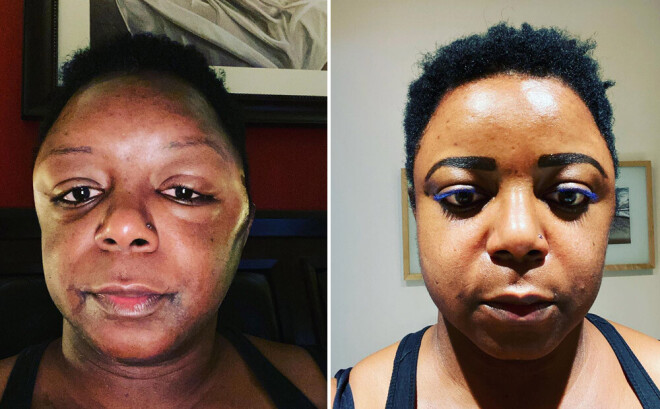 Šerija stāsta, ka pagājis vēl mēnesis, līdz nieze un dedzinošā sajūta no matu krāsas mazinājās.