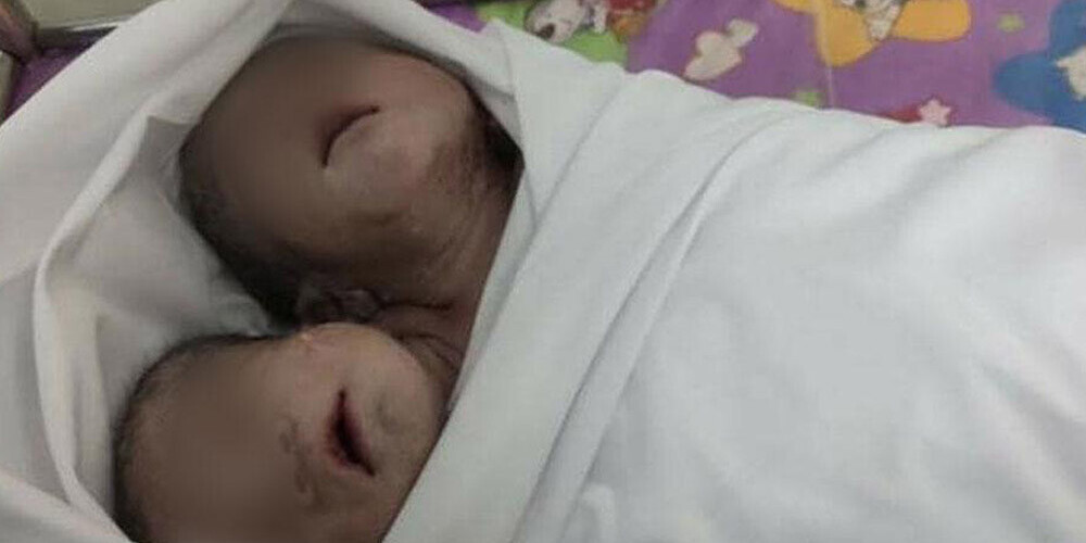 Mjanmas galvaspilsētā piedzimis mazulis ar divām galvām