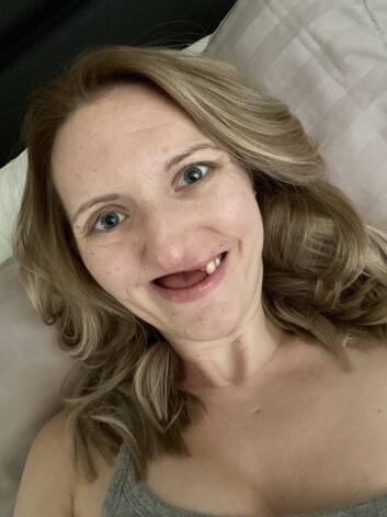 Vēža dēļ 28 gadus vecā sieviete zaudējusi gandrīz visus savus zobus.