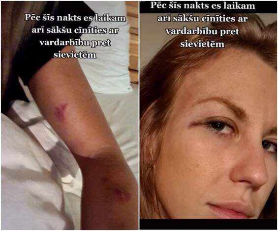 Dziedātāja saviem sekotājiem parādīja iegūtās traumas.
