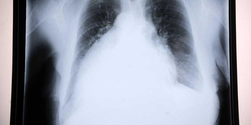 Рентген легких