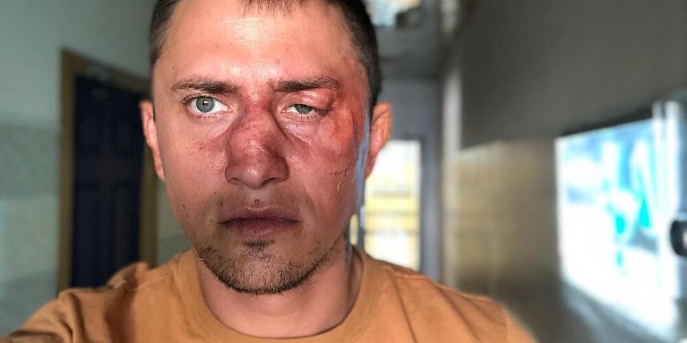 "На меня напали": врачи диагностировали у Павла Прилучного перелом черепа