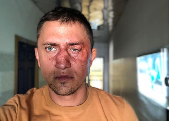 "На меня напали": врачи диагностировали у Павла Прилучного перелом черепа