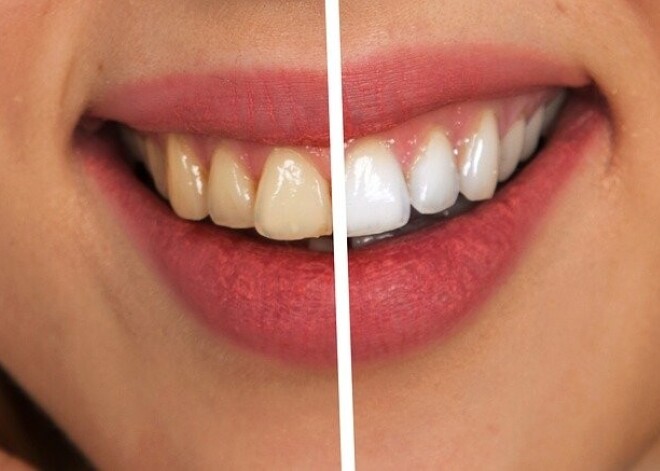 Голливудская улыбка: как отбелить зубы в домашних условиях