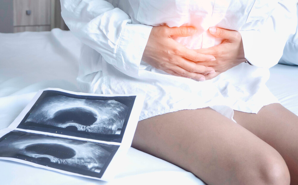 Does an ovarian cyst need surgery?  The gynecologist answers