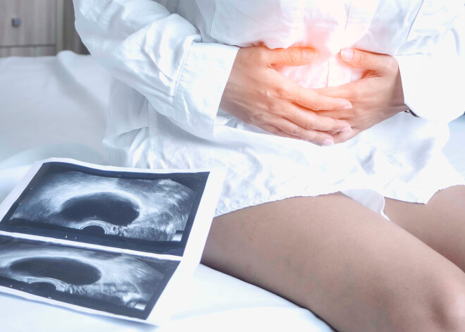 Vai olnīcu cistu vajag operēt? Atbild ginekoloģe