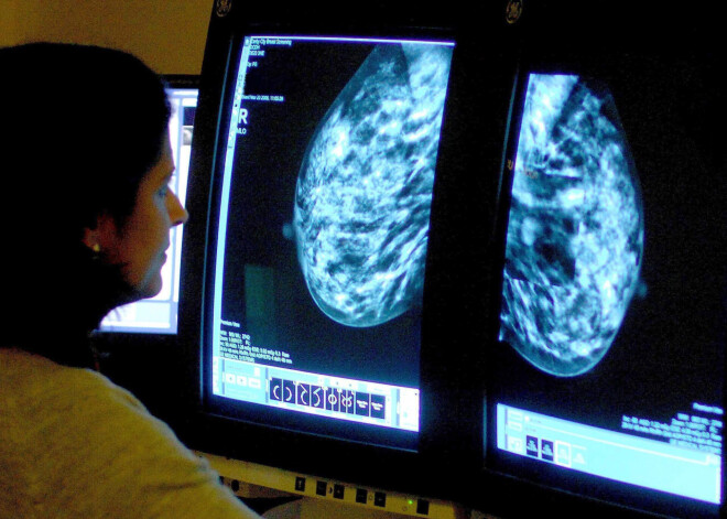 Radiologi ASV ziņo par Covid-19 vakcīnas efektu, kas var lieki satraukt tieši sievietes