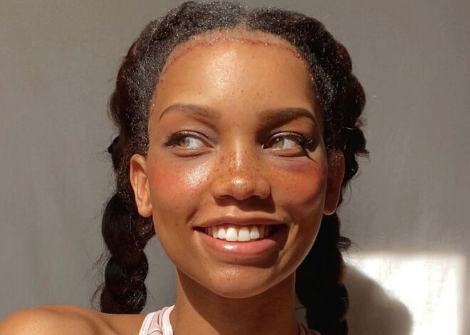 Девушка потратила тысячи на изменение лба, но радости ей это не принесло