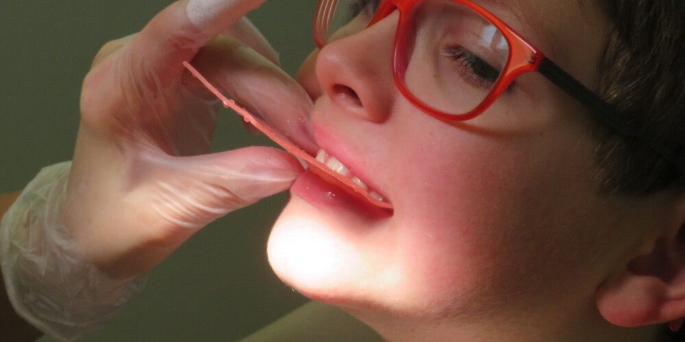 Liepājā uzsākta valsts apmaksāta zobu labošana bērniem pilnā narkozē