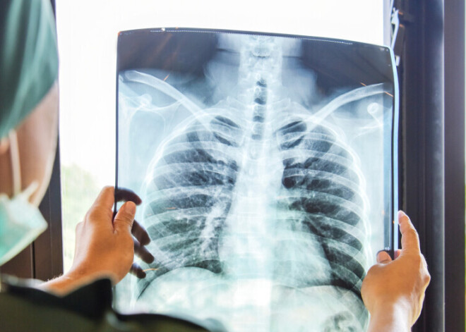 Covid-19: от обычного насморка до пересадки легких. Эстонцу дали возможность жить