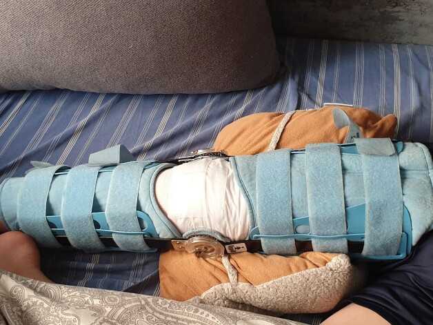 Так выглядит нога мальчика Мартиньша в фиксирующем ортезе, в котором придется побыть некоторое время