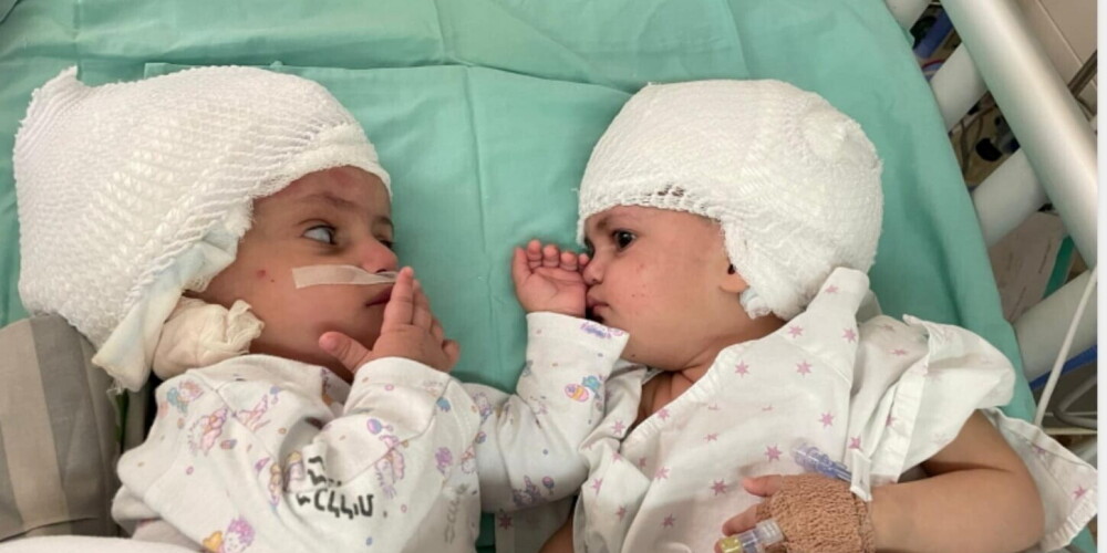 Израильские врачи успешно разделили сиамских близняшек: видео уникальной операции