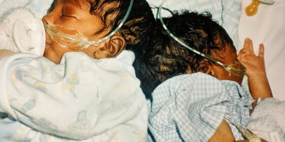 Vienmēr kopā: Siāmas dvīnes tika atdalītas pirms 20 gadiem, bet aizvien guļ blakus