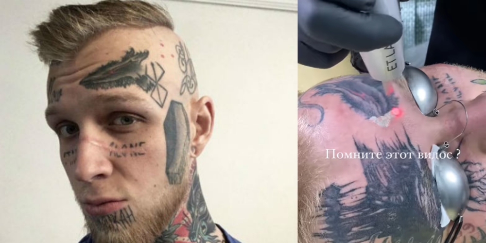 "Представляю, как это адски больно": сын Яковлевой сжег кожу на лице, пытаясь избавиться от татуировок