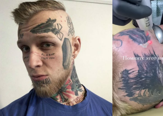 "Представляю, как это адски больно": сын Яковлевой сжег кожу на лице, пытаясь избавиться от татуировок