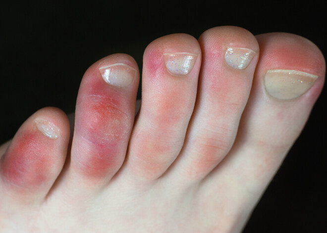 Covid-19: почему появляются "ковидные пальцы"