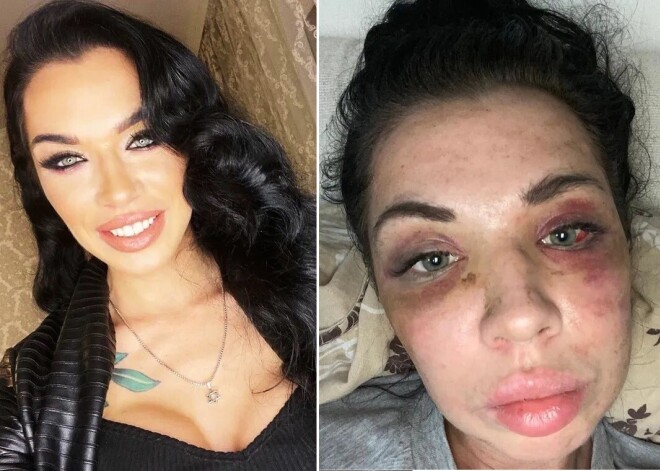 Боец ММА избил свою девушку и отправил на операционный стол