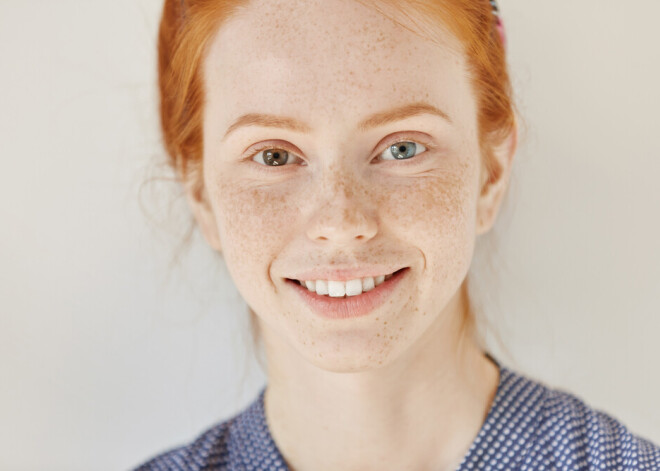 Гетерохромия, дистихиаз и другие привлекательные генетические мутации