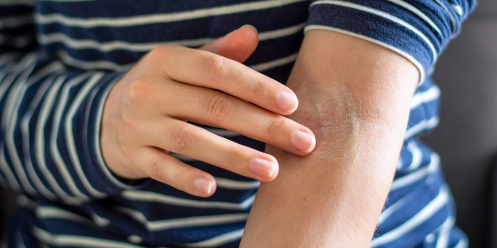 Piecas pazīmes uz ādas, kas varētu liecināt par saslimšanu ar omikronu