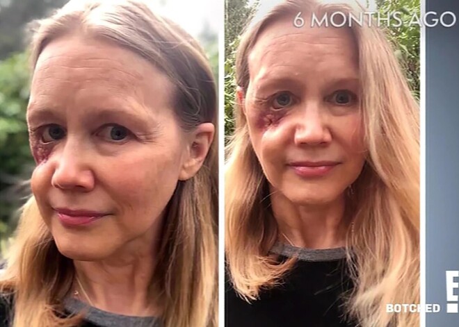 “Es tikai gribēju izskatīties jaunāka!” – neiroloģe Džīna parāda, cik traģiski var izvērsties filleru injekcijas