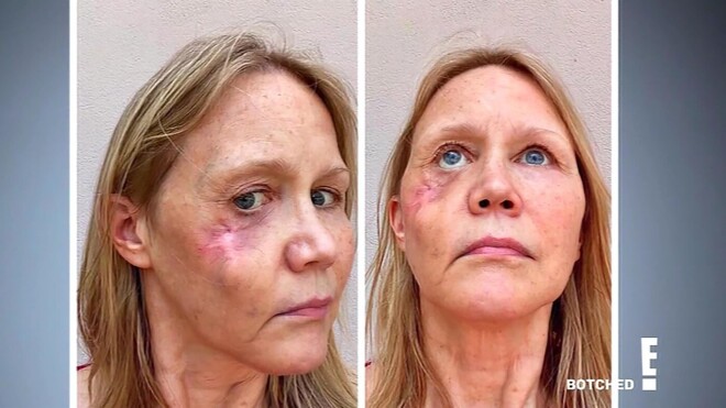 Neiroloģes Džīnas Andersones seja pēc piektās operācijas. 