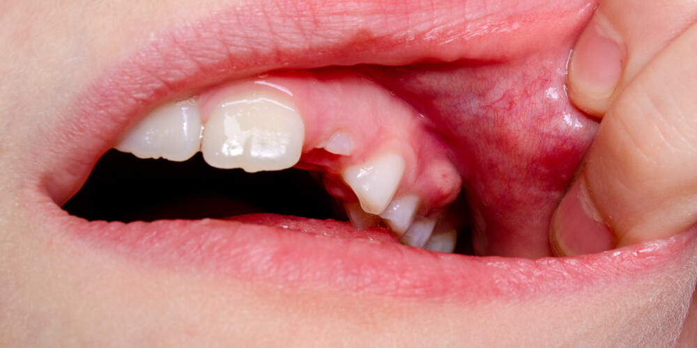 Problēmas ar smaganām var nepamanīt, bet beigās nākas zaudēt arī zobus. Kā zināt, ka nav labi?