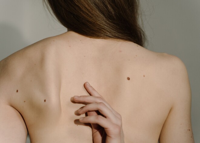 Eiromelanomas nedēļā daļa iedzīvotāju varēs bez maksas pārbaudīt dzimumzīmes