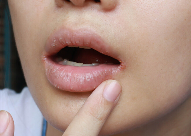 Kāpēc nekad nevajadzētu ignorēt sausuma sajūtu mutē?