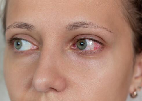 5 cēloņi, kāpēc var rasties sausās acs sindroms