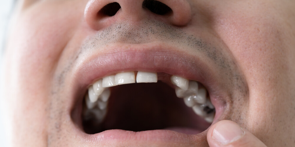 Vai zobu trūkums ir invaliditāte?