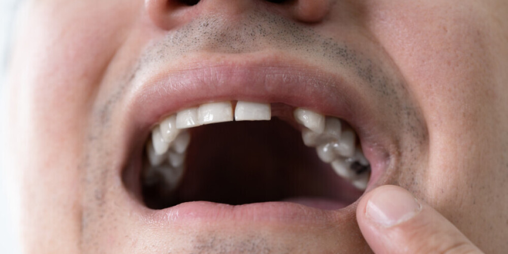 Является ли отсутствие зубов инвалидностью?