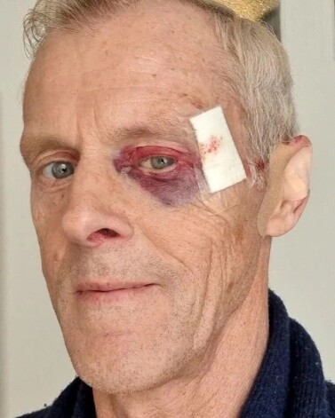 Tāds Māris Šveiduks izskatījās pēc kritiena no elektriskā skrejriteņa.