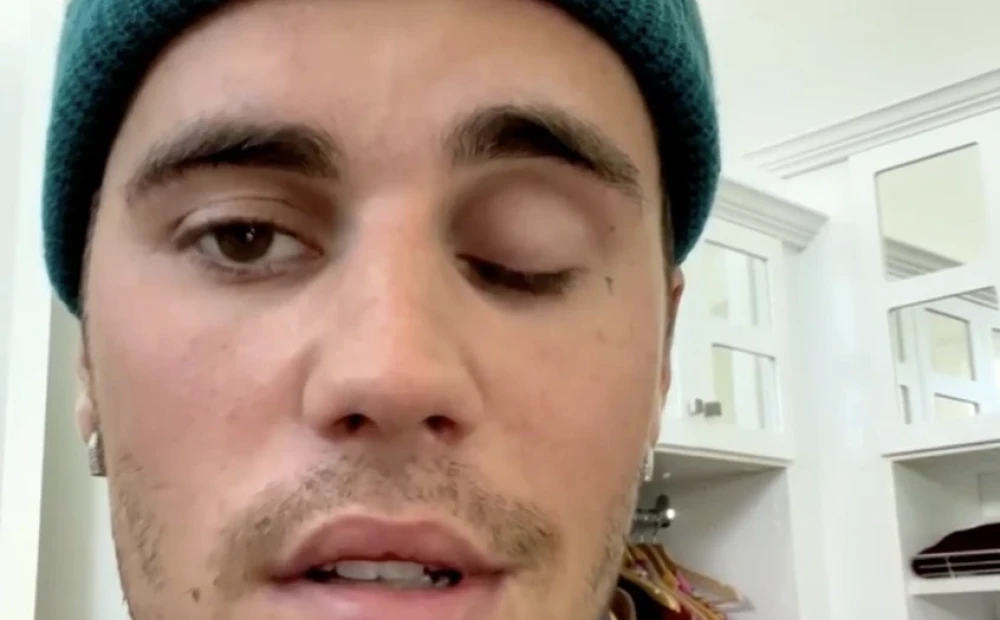 “My body says I need to rest.”  Bieber finds that he suffers from partial facial paralysis