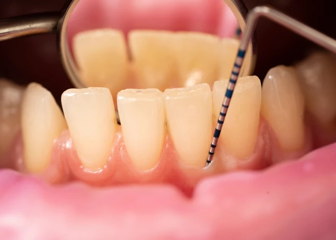 Zobu higiēna. Kāpēc veidojas smaganu kabatas?