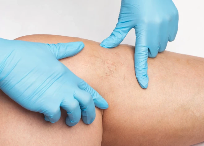 Astoņas pazīmes, kas liecina, ka tavs asinsspiediens nav normāls