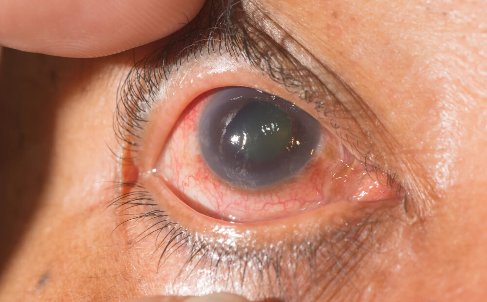 Acu slimības, kas var izraisīt pilnīgu aklumu. Cilvēks pats pirmos simptomus pamanīt nespēs!