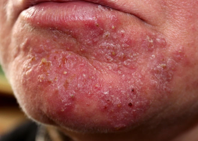 Kādā no Rīgas skolām sākusi izplatīties ļoti lipīgā impetigo infekcija