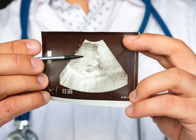 Pētījumā atklāta vēl viena sevišķi nepatīkama Covid-19 blakne, kas saglabājas vēl ilgi pēc atveseļošanās